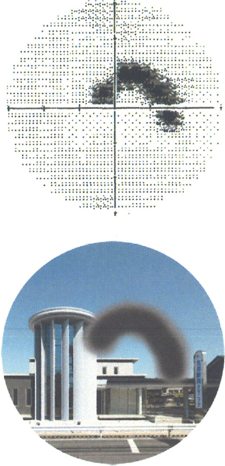 視野欠損の進行　初期