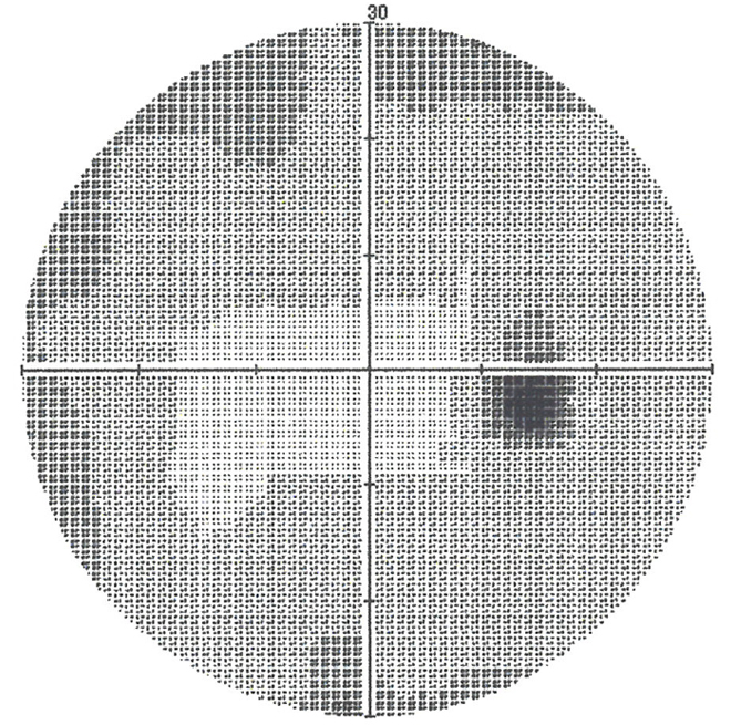 図１（正常視野）