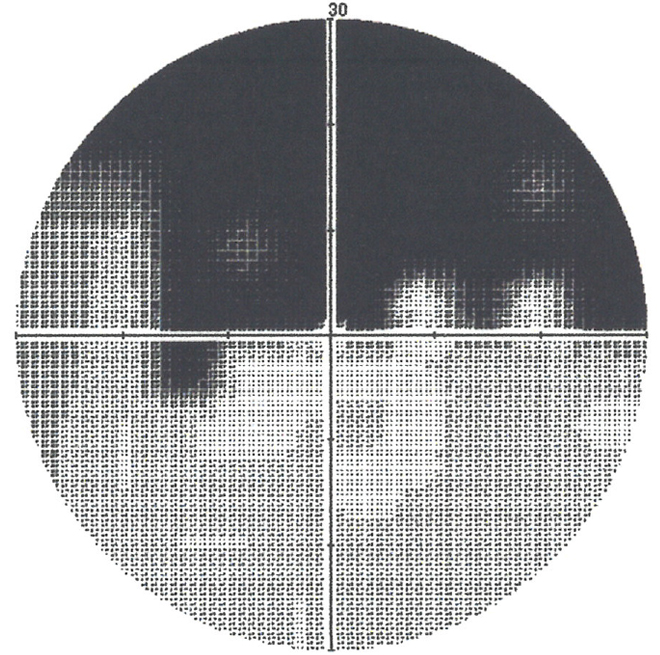 図３（緑内障の視野）